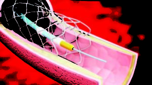 Too many heart procedures being carried out to cash in on insurance coverage